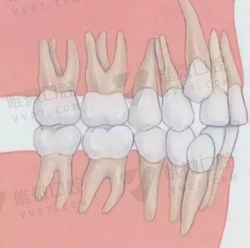 龋齿和牙髓炎疼痛区别（蛀牙和龋齿的区别）请记住这些常识(图1)